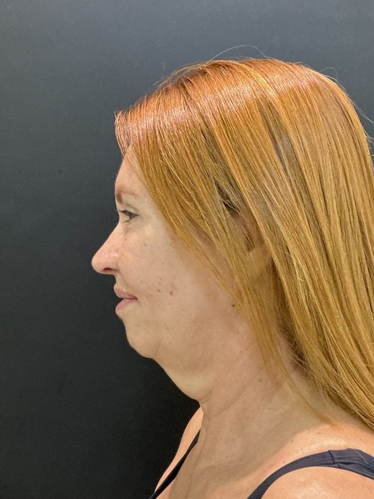 Antes do tratamento - caso 2