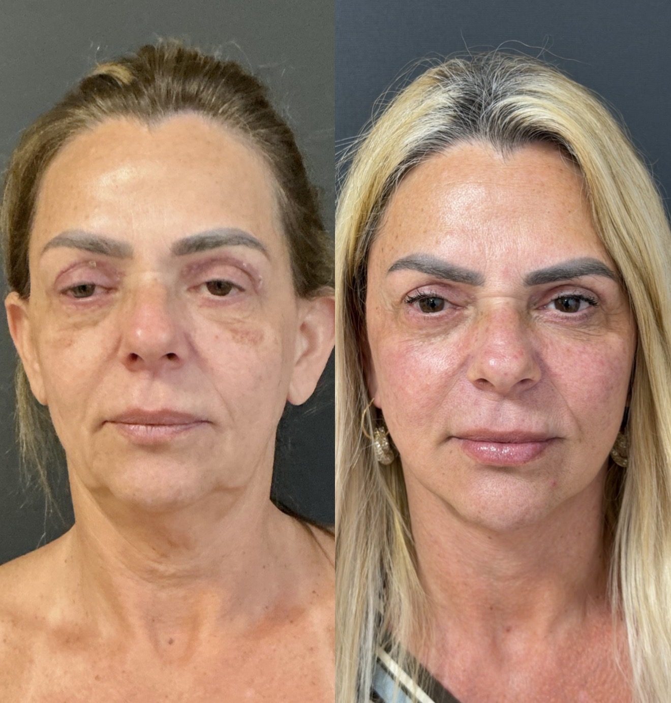 Antes e depois EVVA, caso 1