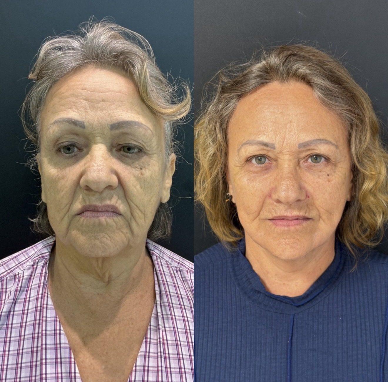 Antes e depois EVVA, caso 2