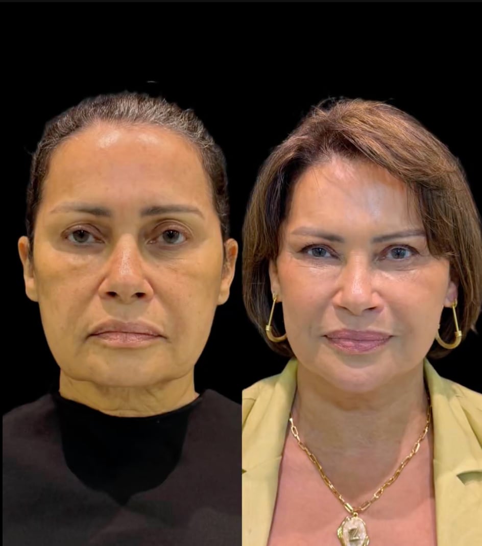 Antes e depois EVVA, caso 3