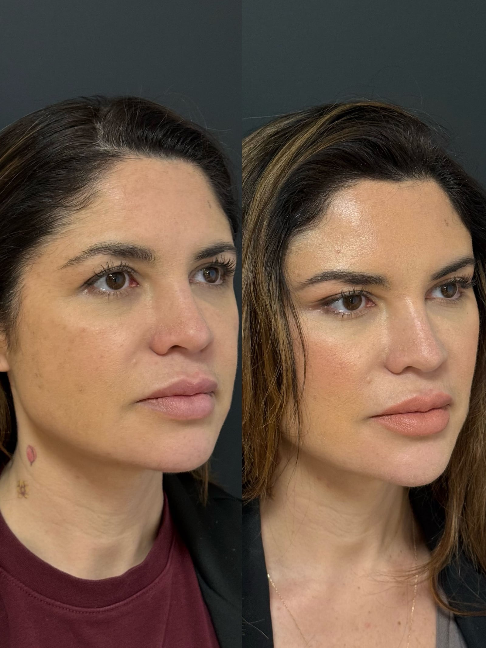 Antes e depois Face Hyden Lifting, caso 1