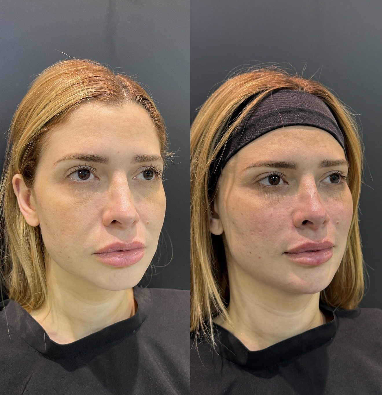 Antes e depois Face Hyden Lifting, caso 2
