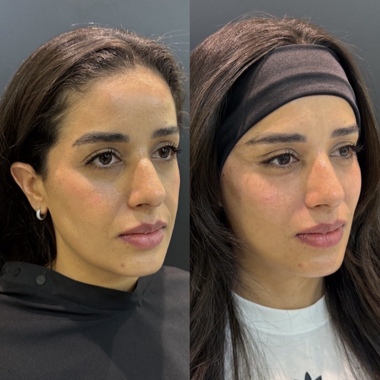 Antes e depois Face Hyden Lifting, caso 3