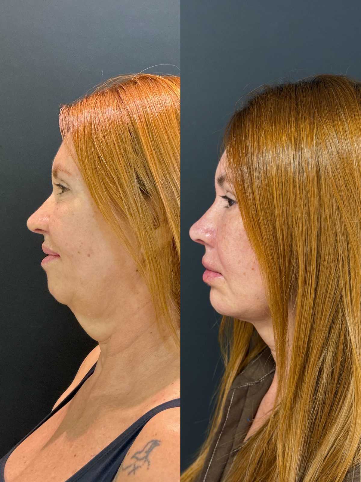 Antes e depois lipo de papada, caso 1