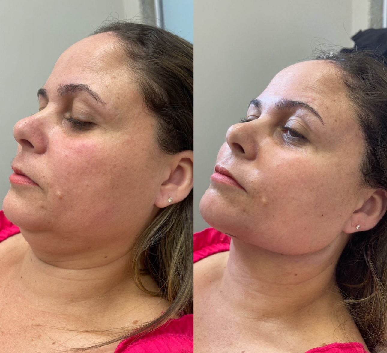 Antes e depois lipo de papada, caso 2