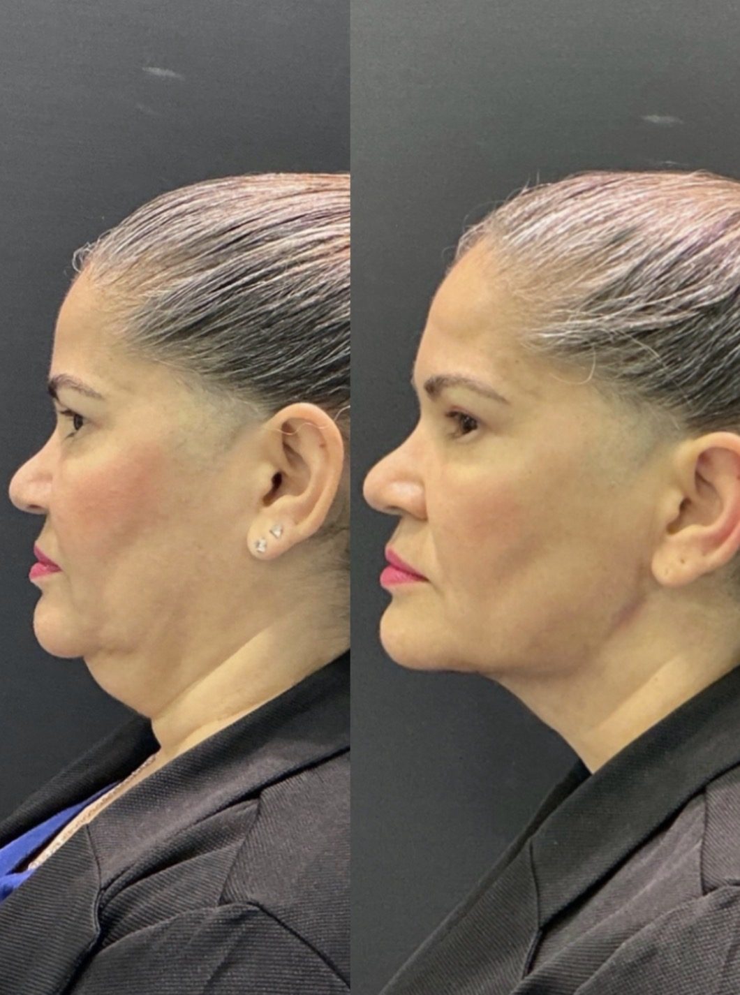 Antes e depois lipo de papada, caso 3