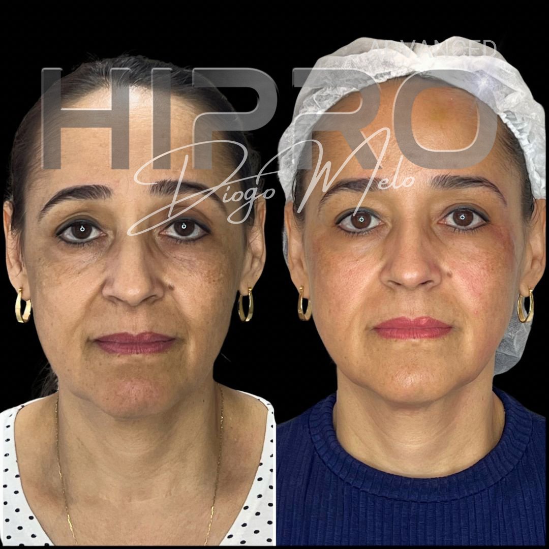 HiproAdv1