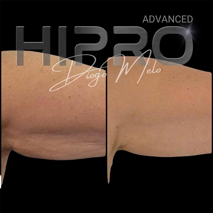 HiproAdv10