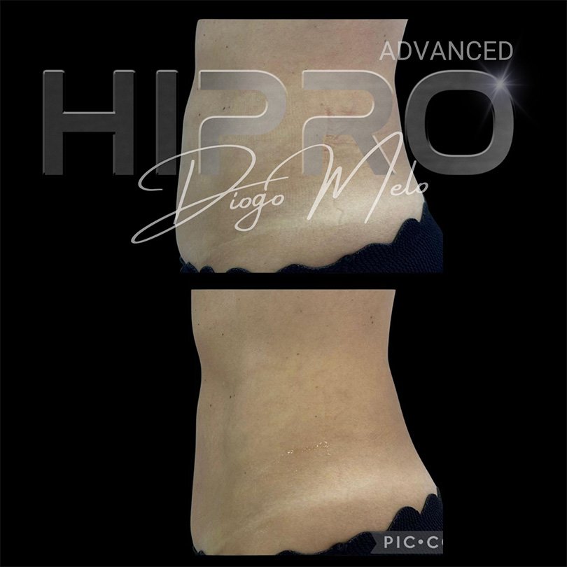 HiproAdv12