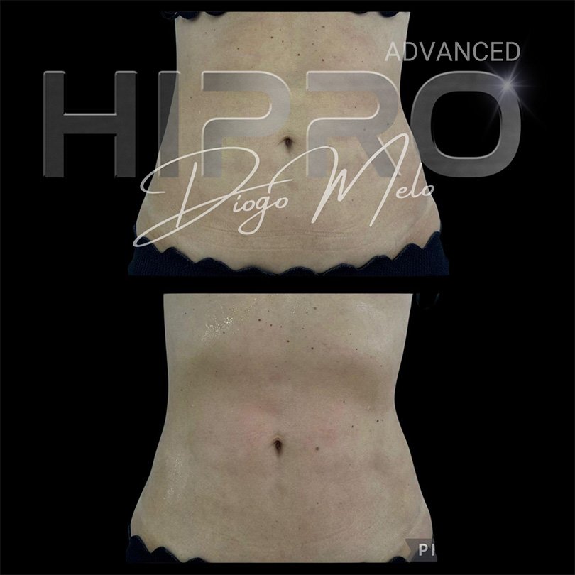 HiproAdv13