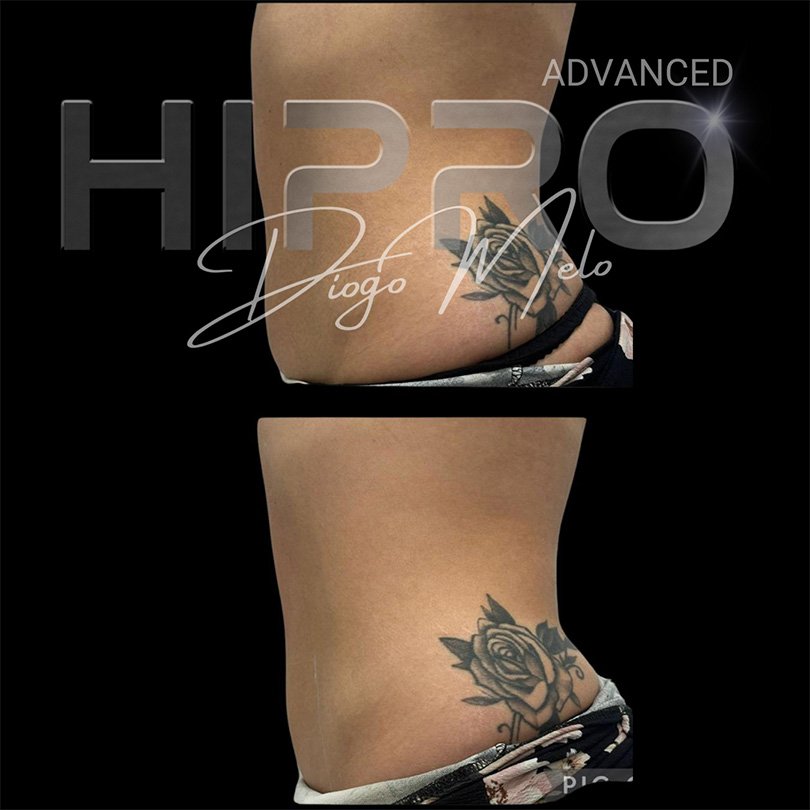 HiproAdv14