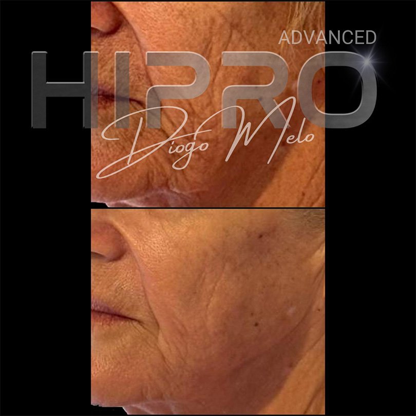 HiproAdv19