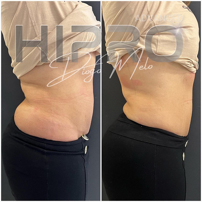 HiproAdv3