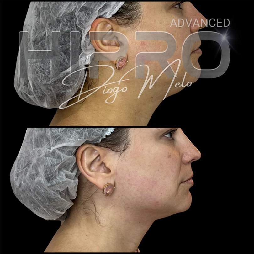 HiproAdv5
