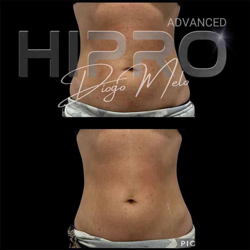 HiproAdv6