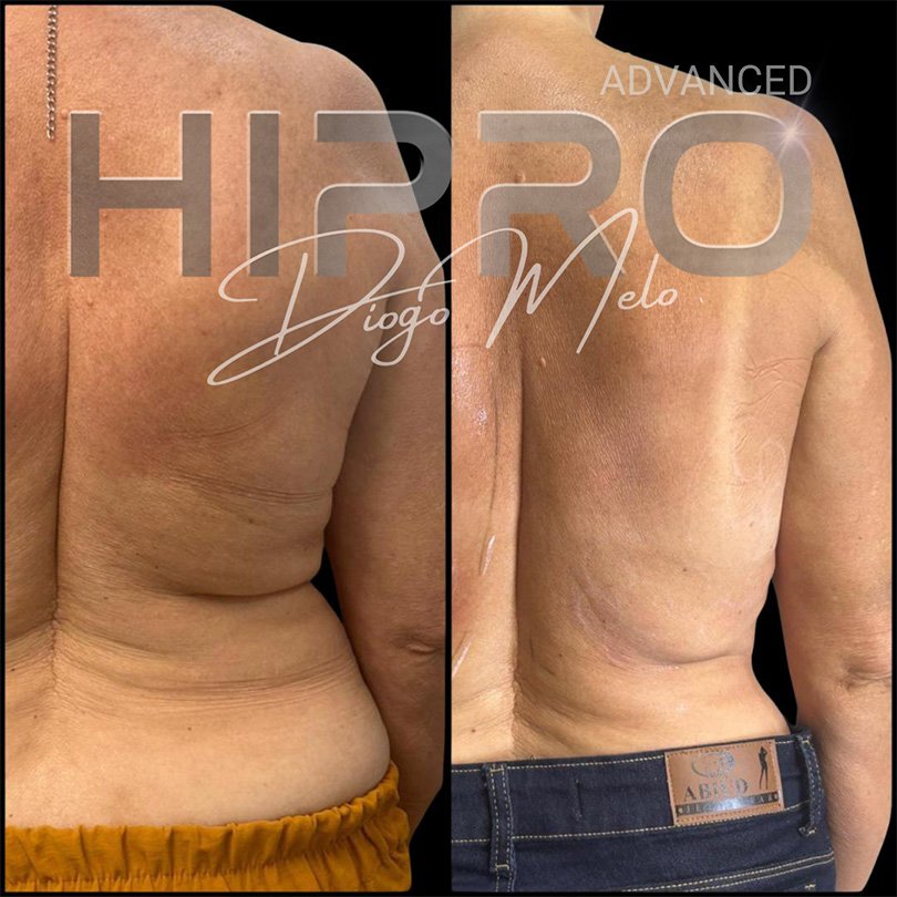 HiproAdv8