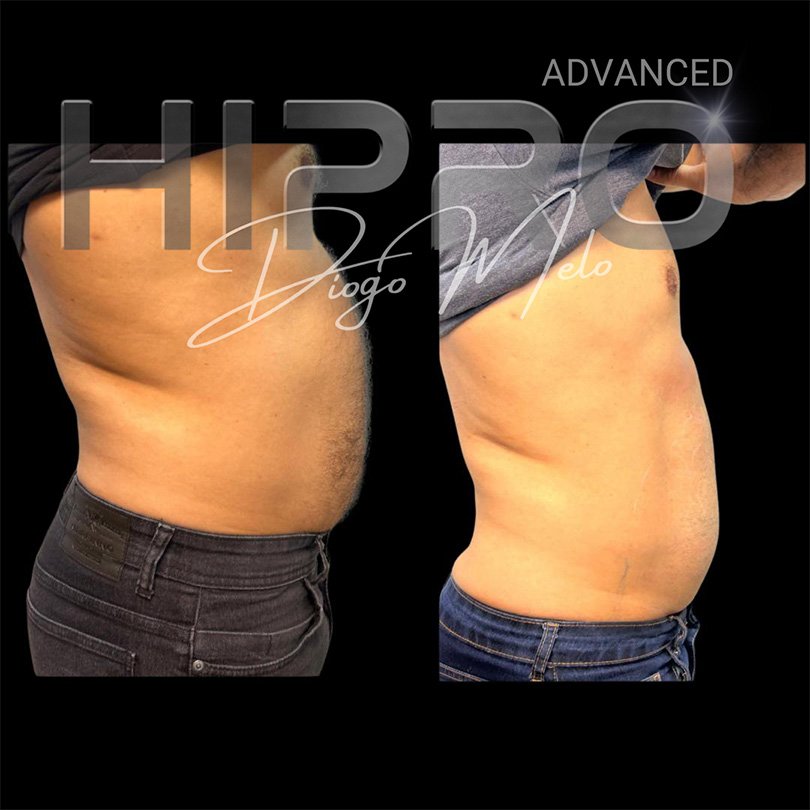 HiproAdv9